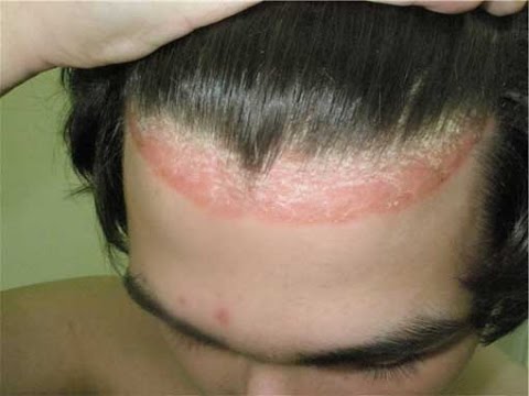 Как эффективно лечить псориаз на коже волосистой части головы в домашних условиях